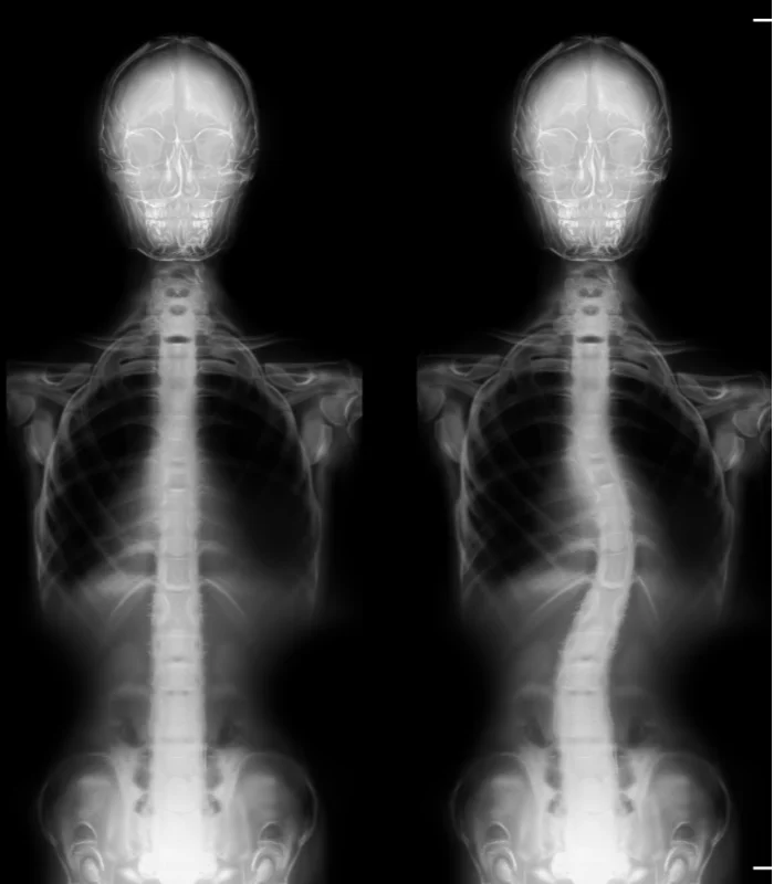 Scoliosis Treatment In Ankeny